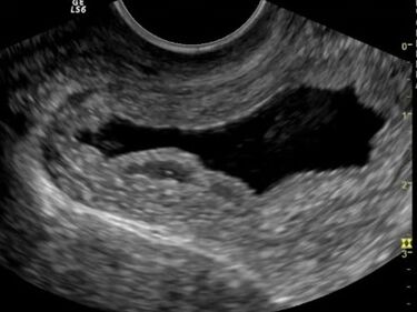 Ultrasound showed chronic cystitis