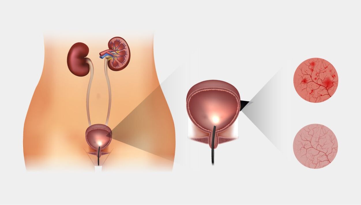 acute and chronic cystitis