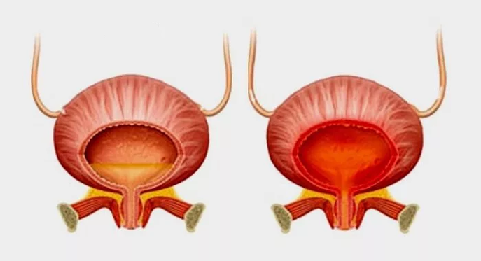 Normal bladder (left) and inflammation of the bladder with cystitis (right)
